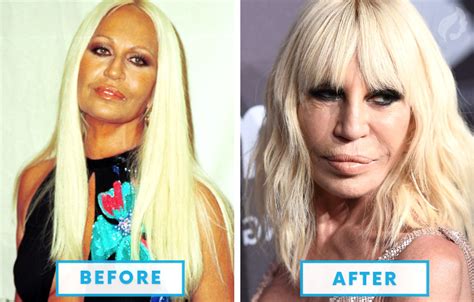 failed plastic surgeries